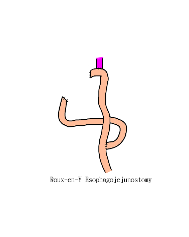 Roux-en-Y EJ